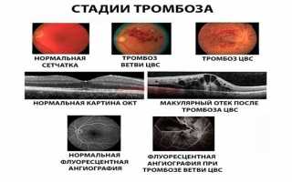 Окклюзия (тромбоз) центральной вены сетчатки — особенности терапии