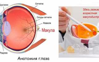 Возрастная макулярная дегенерация — прогрессирующее глазное заболевание