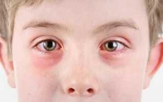 Особенности вирусного конъюнктивита глаз у ребенка: лечение, симптомы, профилактика