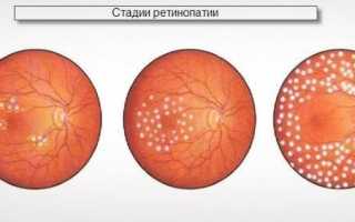 Как определить и лечить диабетическую ретинопатию глаз – опасное осложнение диабета