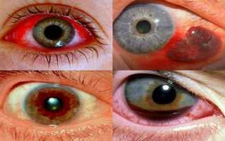 Причины и лечение кровоизлияния в глаз: что делать и как спасти зрение?