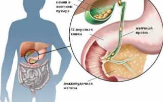 Как выходят камни из желчного пузыря