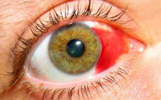 Что такое гемофтальм глаза — чем опасно заболевание для зрения человека