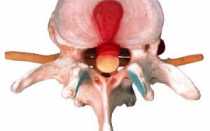 Грыжа межпозвоночного диска L5 S1: виды, симптомы и лечение