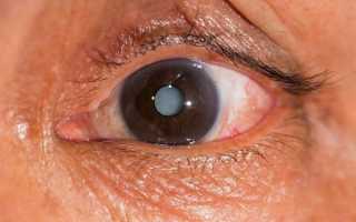 Все о старческой катаракте: виды, причины, лечение и когда нужно бить тревогу?