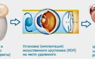 Как и зачем проводится экстракция катаракты: виды операций, реабилитация, стоимость