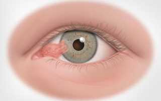 Бывает ли птеригиум глаза злокачественным: причины, симптомы и лечение образования