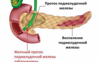 Воспаление поджелудочной железы