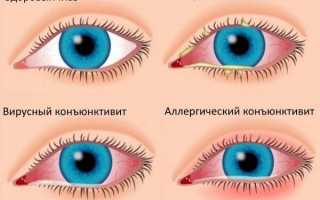 Почему болит глаз изнутри: симптоматика, методы лечения, профилактика