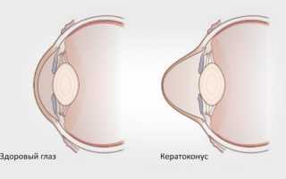 Что такое кератоконус глаз: причины, симптомы и возможные методы лечения