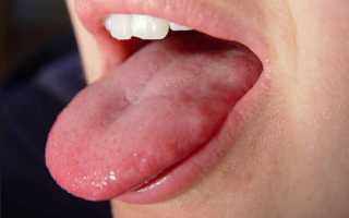 Стоматит на языке лечение у взрослых