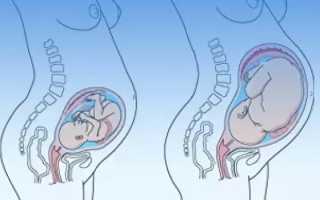 Тошнота во втором триместре беременности