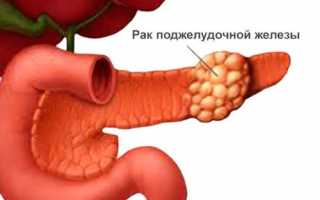 Метастазы в поджелудочной железе при раке