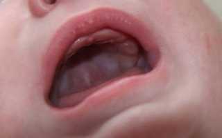 Стоматит у ребенка 1 год