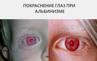 Бывает ли у человека красный цвет глаз: мистика или заболевание?