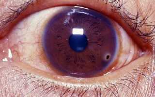 Что делать, если окалина попала в глаз, как не навредить и сохранить зрение?