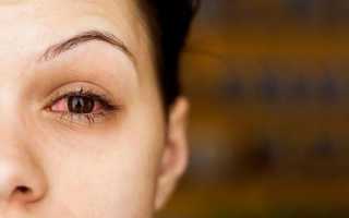 Что делать, если краснеют глаза от линз – 6 простых и действенных советов