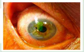 Что такое эрозия глаза — чем опасно заболевание