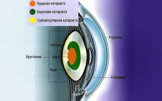 Чем грозит ядерная катаракта, что это такое и как ее лечить?