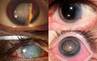 Особенности травматической катаракты и как от нее не ослепнуть?