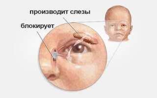 3 метода лечения дакриоцистита у новорожденных детей и особенности болезни