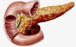 Панкреонекроз поджелудочной железы
