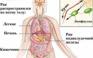 Рак поджелудочной железы 4 стадия