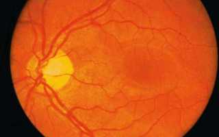 Экскавация диска зрительного нерва при глаукоме
