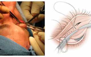 Одно веко опущено ниже другого — как исправить данную патологию