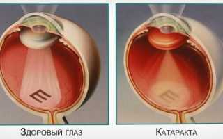Операция при катаракте: единственный ли выход, показания, проведение, восстановление