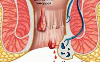 Острый геморрой