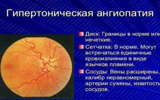 Ангиопатия сосудов сетчатки глаз: методы лечения и профилактика патологии