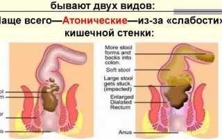 Что это такое атонический запор