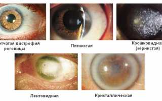 Тонкая роговица глаза: лечение и коррекция патологии