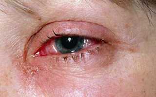 Что делать при ожоге глаз: виды повреждений и оказание первой помощи