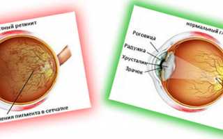 Пигментная дегенерация сетчатки глаз