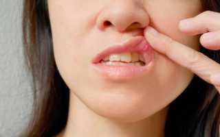 Лекарство от стоматита во рту у взрослых