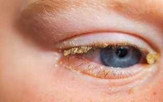 Чем и как правильно промывать глаза при конъюнктивите у ребенка?
