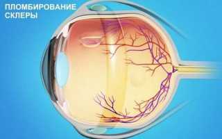 Что такое ретиношизис сетчатки, как остановить прогрессирование и вылечить болезнь