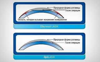 Методики лазерной коррекции астигматизма, как ее делают и какие существуют мифы?