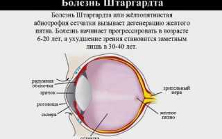 Что нужно знать о болезни Штаргардта, и кто находится в группе риска