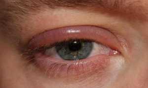 Как и чем снять аллергический отек глаз и опасен ли он для жизни?