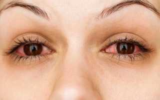 Причины аллергии на глазах и быстрое, эффективное лечение