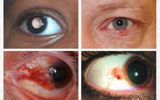 Что такое рак глаз (опухоль): первые симптомы, виды, лечение