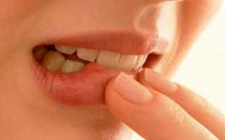 Как проявляется стоматит во рту